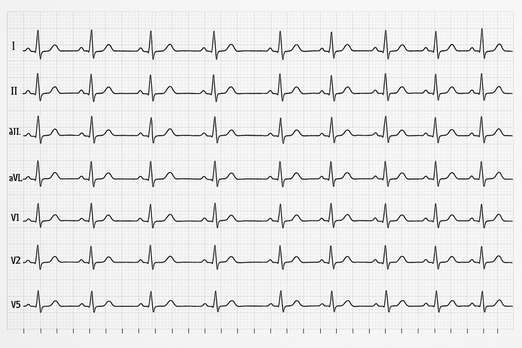 Specialty ECG Electrodes
